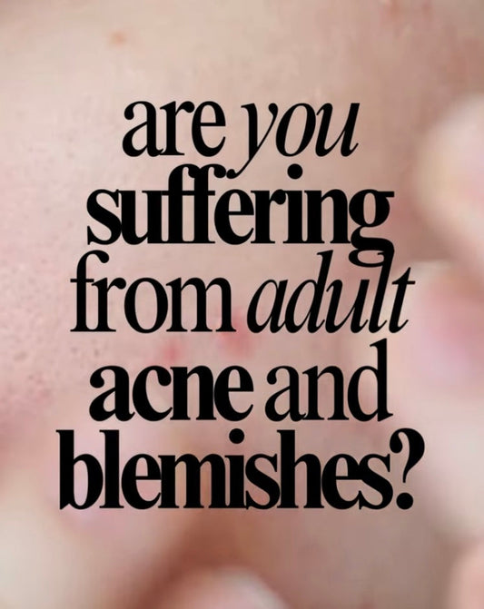 Adult Acne: Why it doesn't have to be complicated
